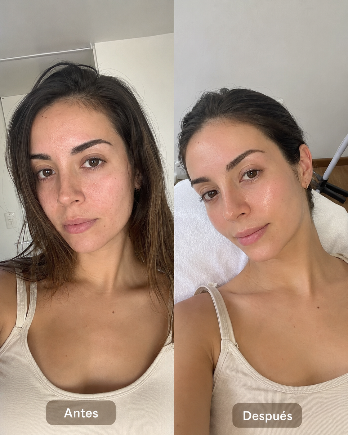Antes / Después — drenaje facial cosmético